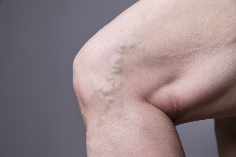 Illustration for article titled How Could Venous Insufficiency Affect You